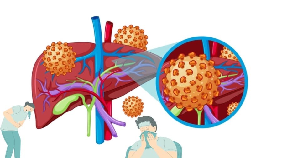 Việt Nam có tỷ lệ người mang virus viêm gan B cao
