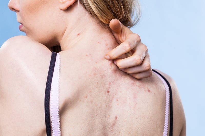 ặc quần áo bó sát, không thấm hút, làm da lưng bí bách và dễ nổi mụn