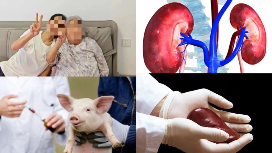 Ca ghép thận lợn biến đổi gene lên người tại Trung Quốc đã giúp bệnh nhân sống hơn 200 ngày