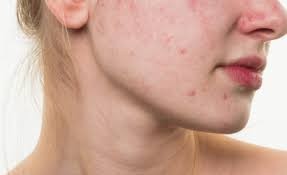 Chế độ ăn nhiều dầu mỡ, đồ chiên rán, ngọt hoặc cay nóng sẽ kích thích tuyến bã nhờn hoạt động mạnh hơn