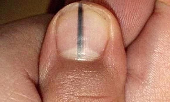 Một dải màu nâu, sẫm hoặc đen chạy dọc theo móng có thể là dấu hiệu của ung thư hắc tố da – dạng ung thư ác tính phát triển từ tế bào hắc tố dưới móng.

