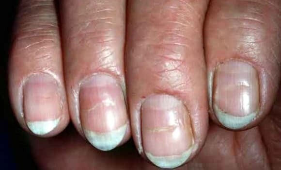 Móng tay xuất hiện các rãnh dọc rõ, giòn và dễ gãy có thể liên quan đến ung thư dạ dày hoặc ung thư thực quản.