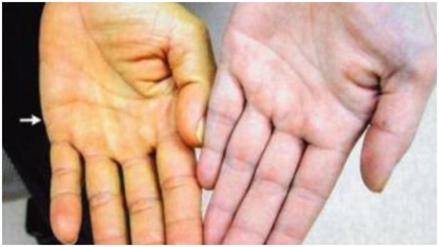Những dấu hiệu cảnh báo bệnh gan nghiêm trọng
