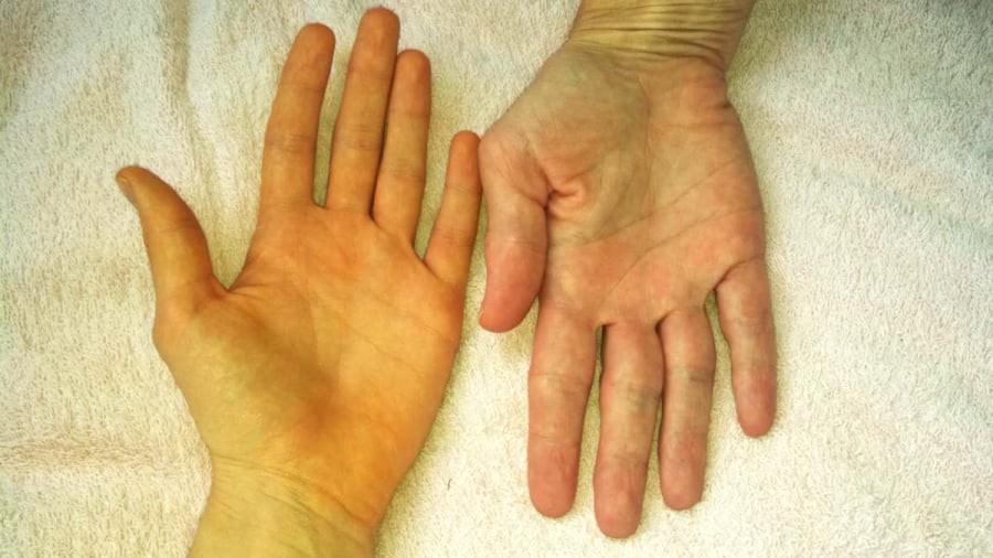 Dấu hiệu bệnh gan nên đi khám