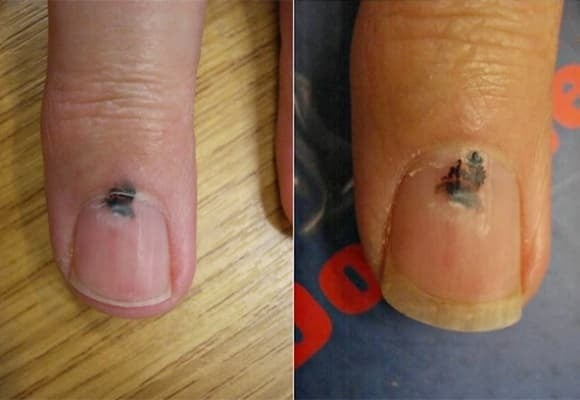 Nếu trên móng tay hoặc móng chân xuất hiện đường sọc hoặc mảng màu đen/nâu sẫm chạy dọc mà không phải do chấn thương, đây có thể là dấu hiệu của ung thư hắc tố dưới móng (Subungual Melanoma).