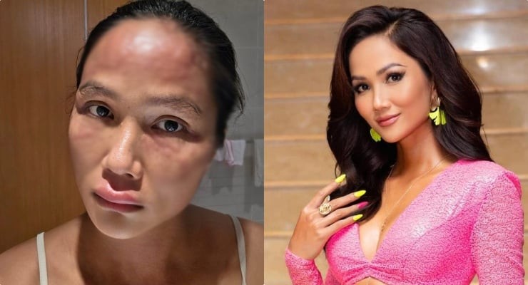 H'Hen Niê mắc bệnh sau sinh, tỉ lệ 1/10 người phụ nữ sinh gặp phải