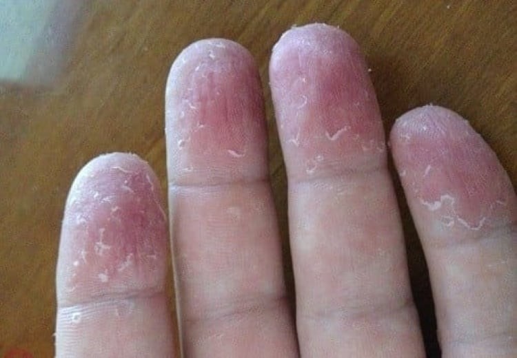 Bong tróc da tay có nhiều nguyên nhân, có thể do cơ địa dị ứng, viêm da cơ địa... (Ảnh minh họa)