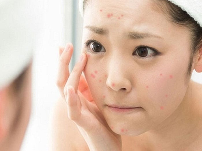 Che khuyết điểm là cứu tinh của những ai có làn da không đều màu hoặc có mụn. 