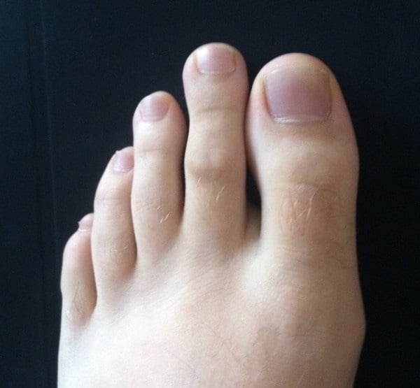 Bàn chân Hy Lạp – Ngón thứ hai dài hơn ngón cái

