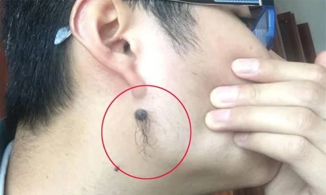 Lông trên nốt ruồi mọc nhiều thì người đó chắc chắn có tướng địa phú đại quý. (Ảnh minh họa)