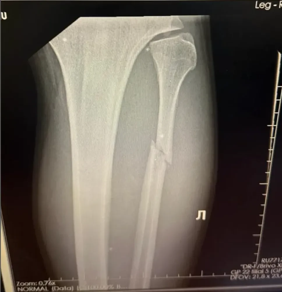 Hình ảnh X-quang xác nhận xương mác của Valter Walker đã gãy làm đôi.