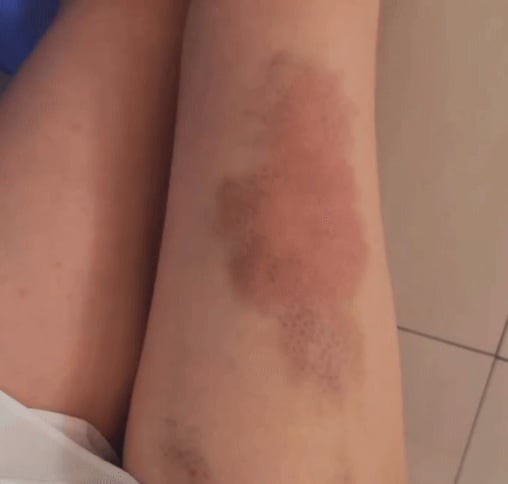  Tiểu Vy lộ đôi chân bầm tím khiến fan lo lắng