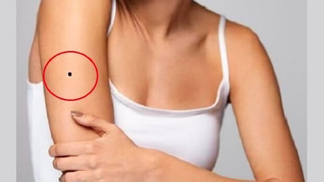 Nốt ruồi ở cánh tay. (Ảnh minh họa)