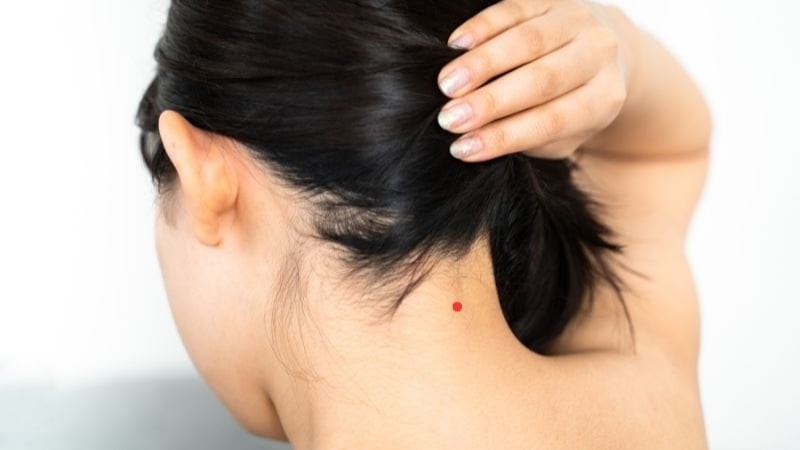  Nốt ruồi phía sau gáy. (Ảnh minh họa)