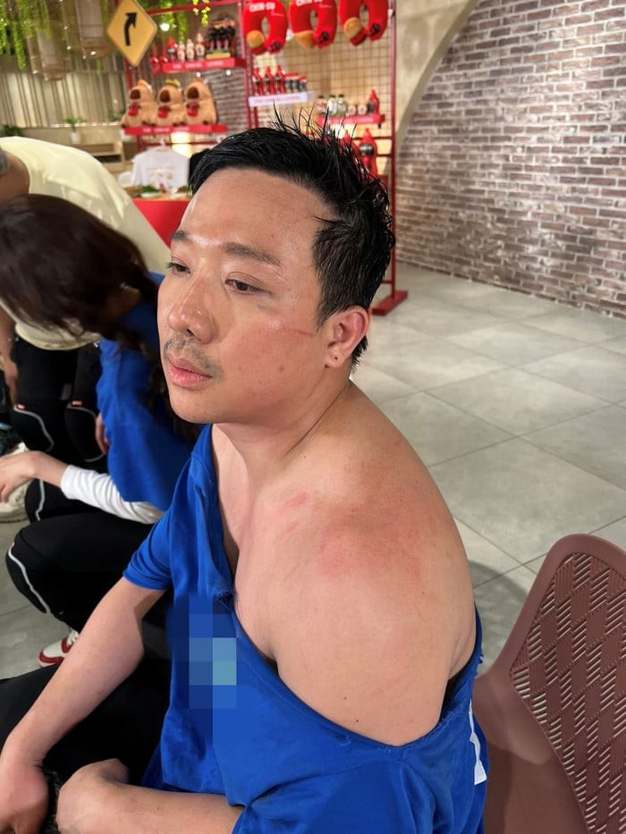 Hình ảnh được Trấn Thành chia sẻ cho thấy những vết trầy xước, bầm tím xuất hiện trên gò má, cằm và vai. 

