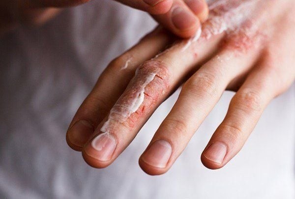 Khi không được cấp ẩm đầy đủ, da tay dễ trở nên khô căng, đau rát mỗi khi cử động.