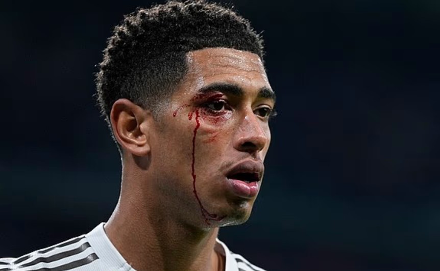 Máu đổ trên mặt Bellingham.