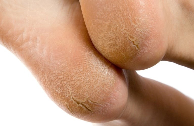 Đu đủ chín vốn giàu enzyme tự nhiên và vitamin, đặc biệt khi kết hợp cùng một chút nước cốt chanh sẽ tạo thành hỗn hợp hỗ trợ làm mềm lớp sừng trên da gót chân. 