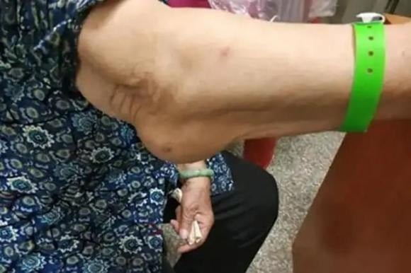 Hạch bạch huyết sưng ở vùng cánh tay – đặc biệt là nách – thường bị nhầm lẫn với viêm nhiễm nhẹ.