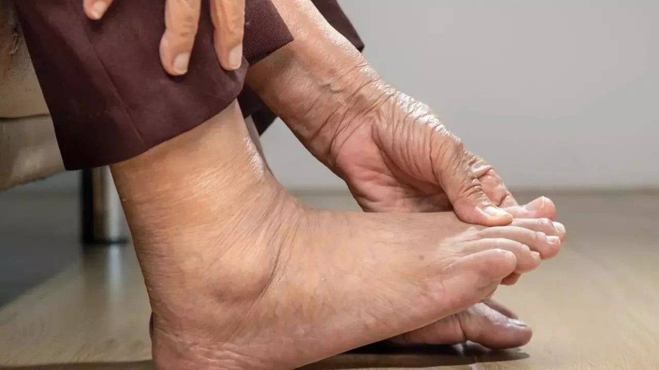 Các bác sĩ cho biết, tình trạng tuần hoàn máu suy giảm do tim hoạt động kém có thể bộc lộ qua ba dấu hiệu bất thường ở chân. Ảnh minh họa