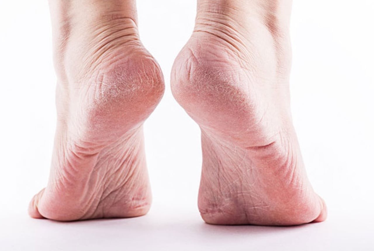 Nếu bạn thấy gót chân của mình liên tục nứt nẻ và kem dưỡng ẩm không thể cải thiện tình trạng này, hãy cảnh giác với 5 tình trạng này. (Ảnh minh họa)