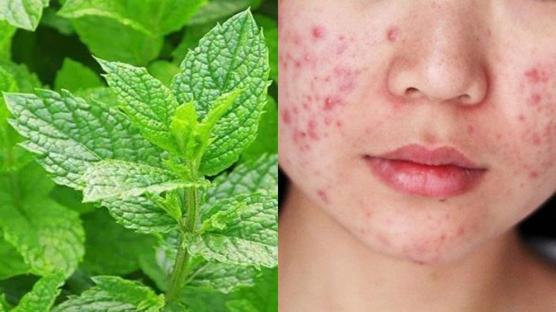 Nhờ đặc tính kháng khuẩn và kháng nấm, bạc hà thường được sử dụng để hỗ trợ làm dịu các nốt mụn sưng đỏ. 