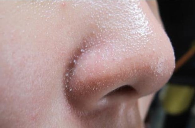 Các nhóm hoạt chất như AHA và BHA hoạt động theo cơ chế hòa tan lớp sừng già cỗi, giúp loại bỏ cặn bẩn nằm sâu trong lỗ chân lông.

