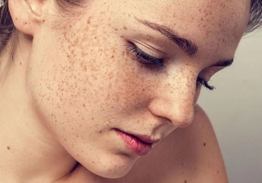 Ngoài yếu tố môi trường, sự tích tụ độc tố trong cơ thể và rối loạn nội tiết cũng góp phần làm mất cân bằng sắc tố.