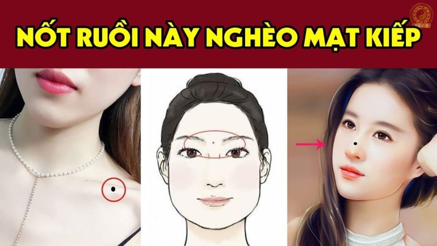 Nốt ruồi may mắn 