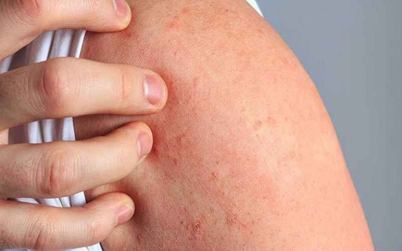 Quá trình mất nước diễn ra đột ngột làm các tế bào da co rút, kích thích các đầu dây thần kinh cảm giác và tạo ra cảm giác ngứa, rát hoặc châm chích như kiến bò.