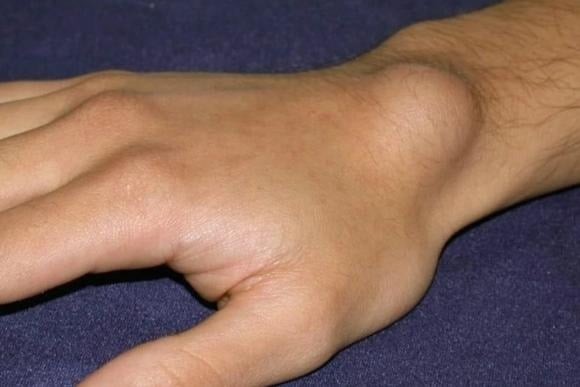 Việc cơ thể xuất hiện các khối hạch lạ có thể là dấu hiệu cho thấy tế bào ung thư đang lan truyền qua hệ bạch huyết.