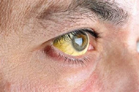 Theo thời gian, màu sắc có thể sẫm hơn đôi chút, tuy nhiên nếu lòng trắng mắt bất ngờ chuyển sang vàng và kèm theo hiện tượng da vàng dần, đây có thể là dấu hiệu cho thấy chức năng gan đang gặp vấn đề, chẳng hạn như viêm gan hoặc xơ gan.