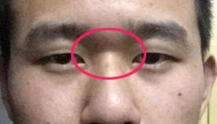 Đường cắt ngang gốc mũi. (Ảnh minh họa)