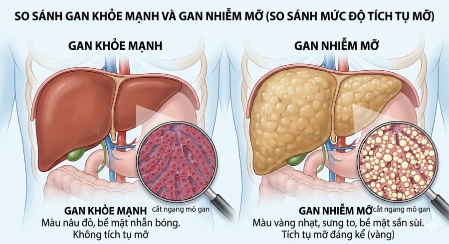 Gan nhiễm mỡ xảy ra khi lượng mỡ tích tụ trong tế bào gan vượt mức bình thường, thường liên quan đến chế độ ăn và lối sống.