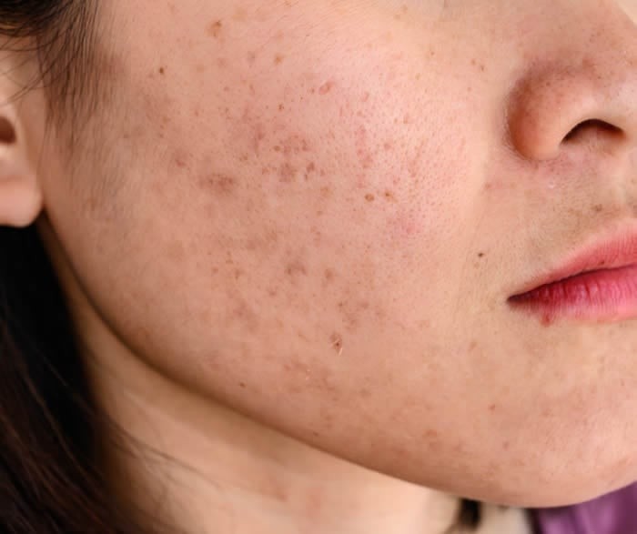  Theo bác sĩ da liễu Michele Green, các thành phần thuộc nhóm này có thể giúp loại bỏ lớp tế bào da cũ chứa sắc tố dư thừa, từ đó hỗ trợ làm mờ đốm nâu theo thời gian.