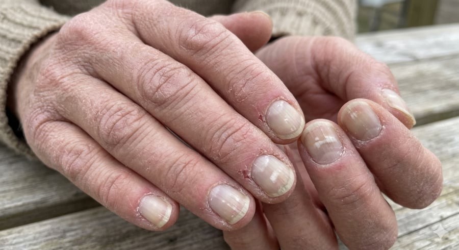 Da khô, móng tay đổi màu hoặc dễ gãy đôi khi phản ánh những thay đổi trong cơ thể, trong đó có thể liên quan đến sức khỏe thận.