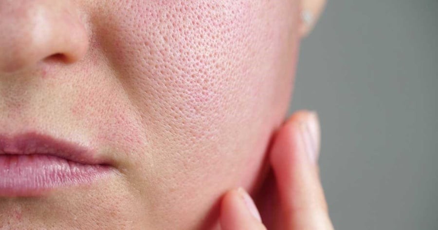 Nếu vi khuẩn P. acnes phát triển mạnh, da còn dễ xuất hiện mụn viêm và sưng đỏ.