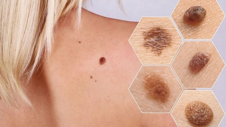 Ung thư da nếu được phát hiện sớm thì khả năng điều trị khỏi rất cao.