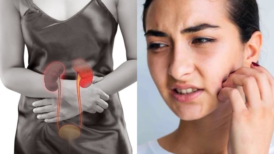 Khi thận suy yếu, người bệnh có thể gặp tình trạng mẩn ngứa ở mặt và cổ.