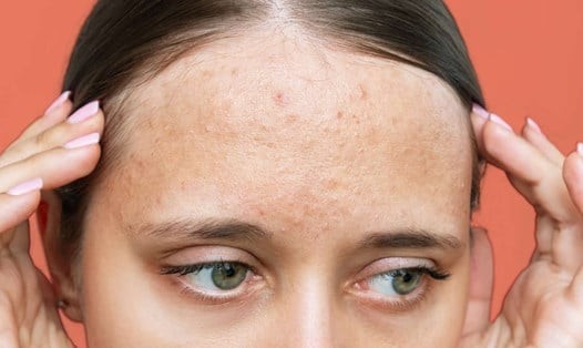 Sự đứt gãy của collagen và elastin khiến bề mặt da mất đi độ đàn hồi và trở nên kém mịn.