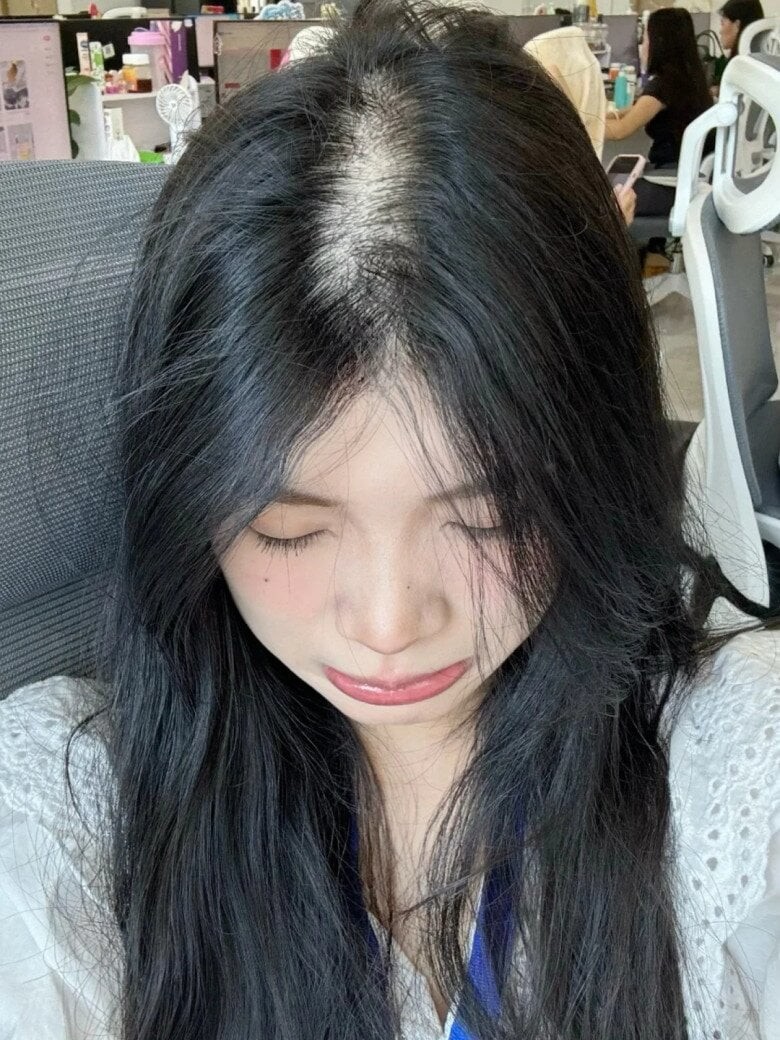 Khi da đầu thường xuyên trong trạng thái nhờn, dễ bết, thậm chí xuất hiện các nốt kích ứng nhỏ, đó là dấu hiệu cho thấy môi trường da đầu đang bị rối loạn