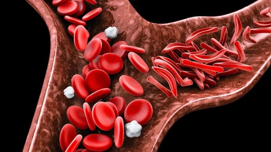 Thiếu ngủ và mệt mỏi cũng làm tăng nguy cơ. 