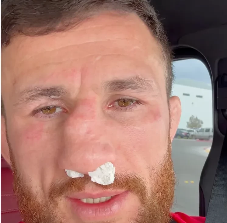 Hình ảnh chiếc mũi bị gãy của Merab Dvalishvili