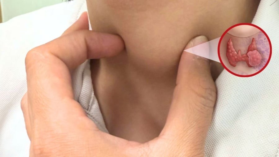 Chế độ ăn thiếu i-ốt là một trong những yếu tố làm tăng nguy cơ bị ung thư tuyến giáp.