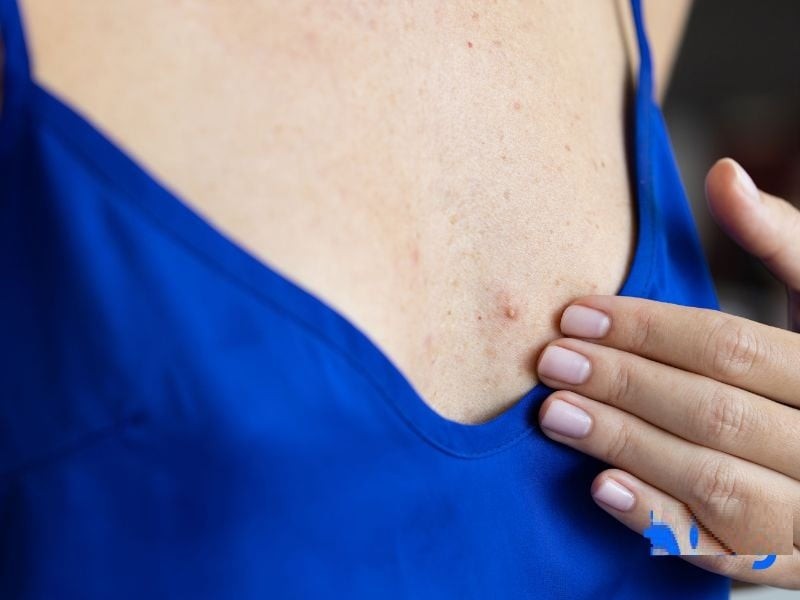 5 dấu hiệu nhận biết ung thư vú từ sớm, số 1 biết sớm chữa được ngay