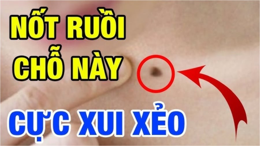 Nốt ruồi xui xẻo nên xóa bỏ