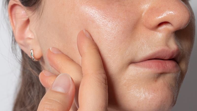 Khi nhiệt độ tăng cao, tuyến bã nhờn hoạt động mạnh hơn, khiến da dễ rơi vào trạng thái dư dầu và mất cân bằng. 