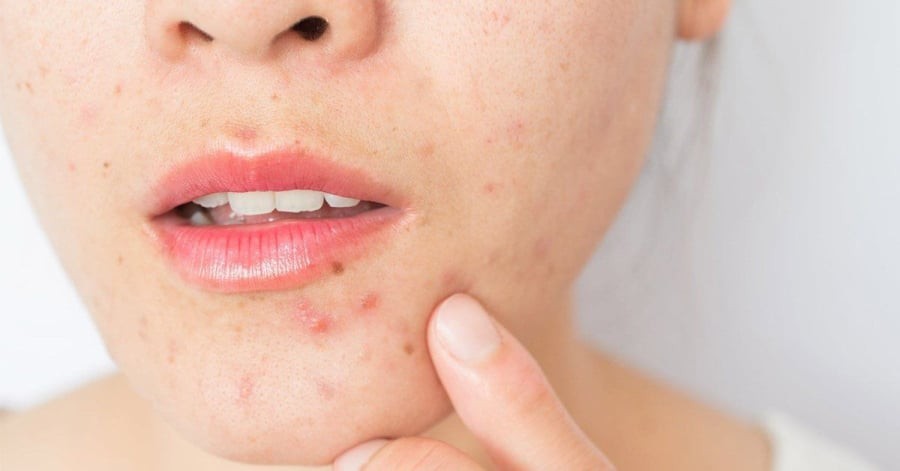 Một trong những nguyên nhân khiến mụn trở nên nghiêm trọng hơn là việc tự ý nặn khi mụn chưa “chín”.