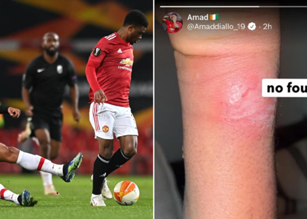 Manchester United starlet Amad Diallo shows off battle scar and fumes over Granada foul - Bóng Đá