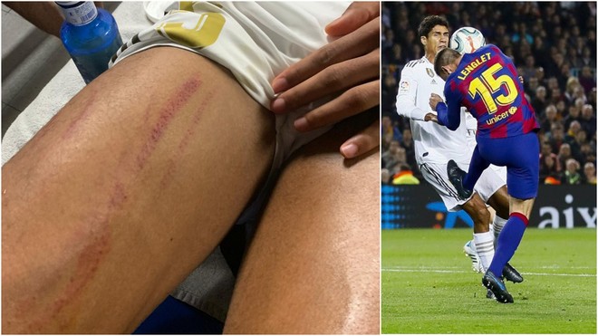 Varane reveals the mark left by Lenglet's studs - Bóng Đá